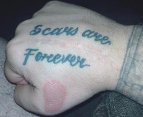 hand-scar